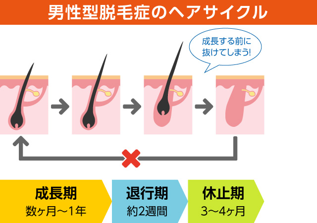 宇都宮のノアAGAクリニックが薄毛の原因を解説