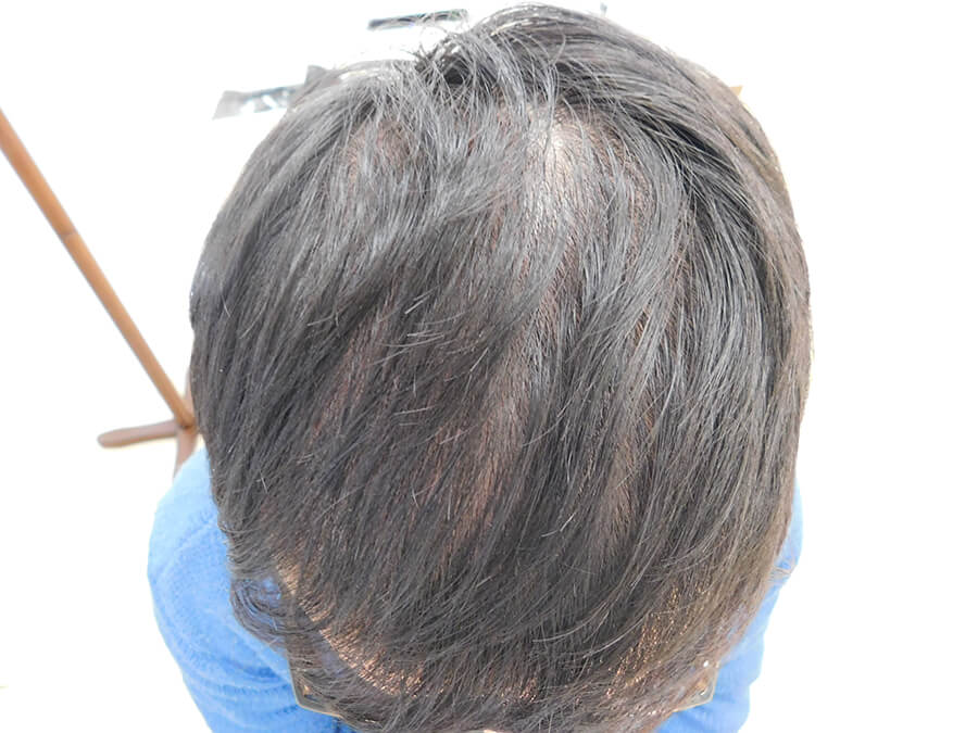 薄毛の改善事例 25歳男性 10か月後 宇都宮でaga治療ならノアagaクリニック宇都宮院