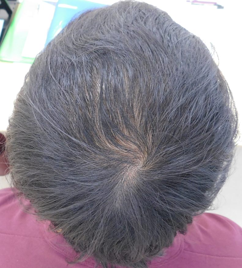 薄毛の改善事例 27歳男性 6ヶ月後 宇都宮でaga治療ならノアagaクリニック宇都宮院