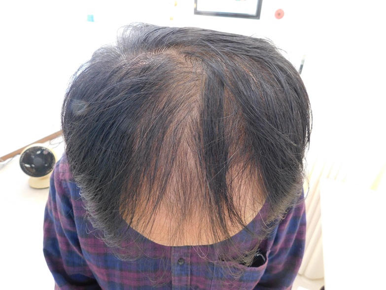薄毛の改善事例 40代男性 9か月後 宇都宮でaga治療ならノアagaクリニック宇都宮院