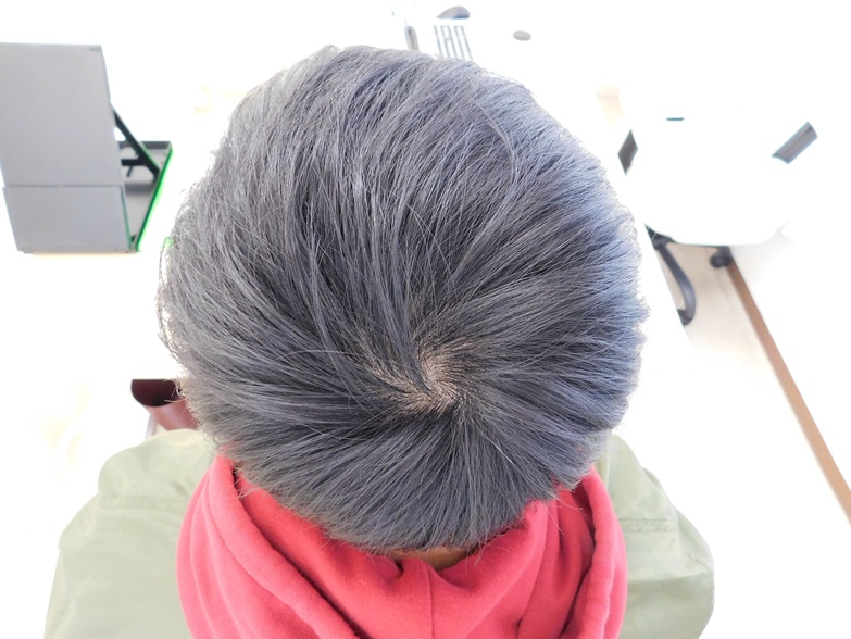 薄毛の改善事例 代男性 6か月後 宇都宮でaga治療ならノアagaクリニック宇都宮院