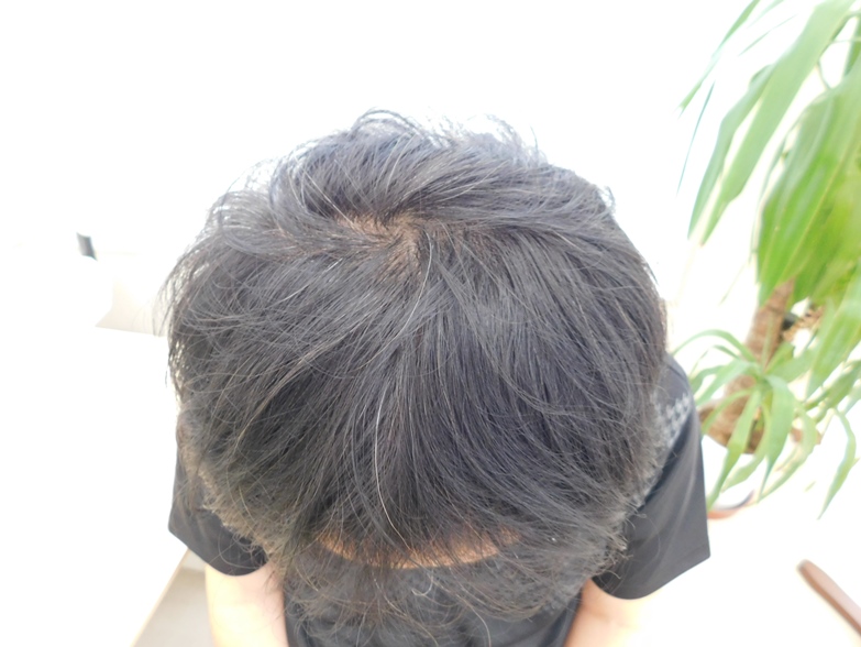 薄毛の改善事例 40代男性 9か月後 宇都宮でaga治療ならノアagaクリニック宇都宮院
