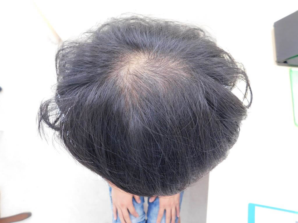 薄毛の改善事例 40代男性 6か月後 宇都宮で薄毛治療ならノアagaクリニック宇都宮院 薄毛の改善事例 40代男性 6か月後 宇都宮で薄毛治療ならノアagaクリニック宇都宮院